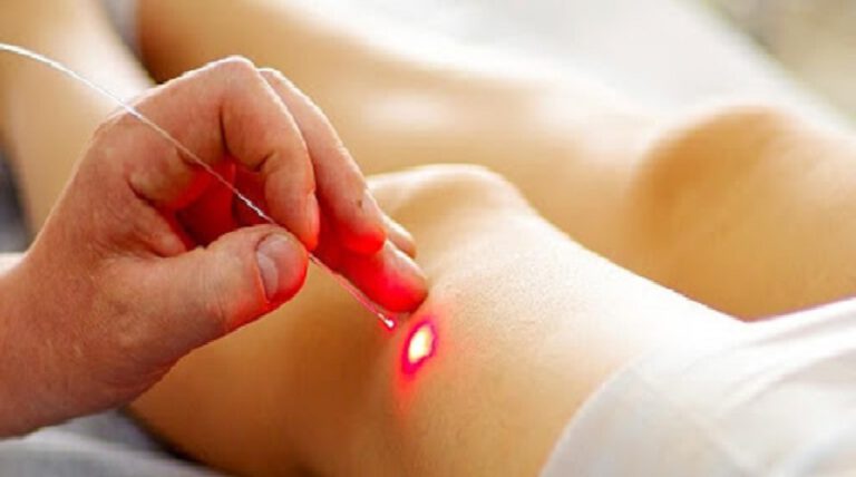 Ce nouveau système laser tue le cancer en quelques secondes sans endommager les tissus sains