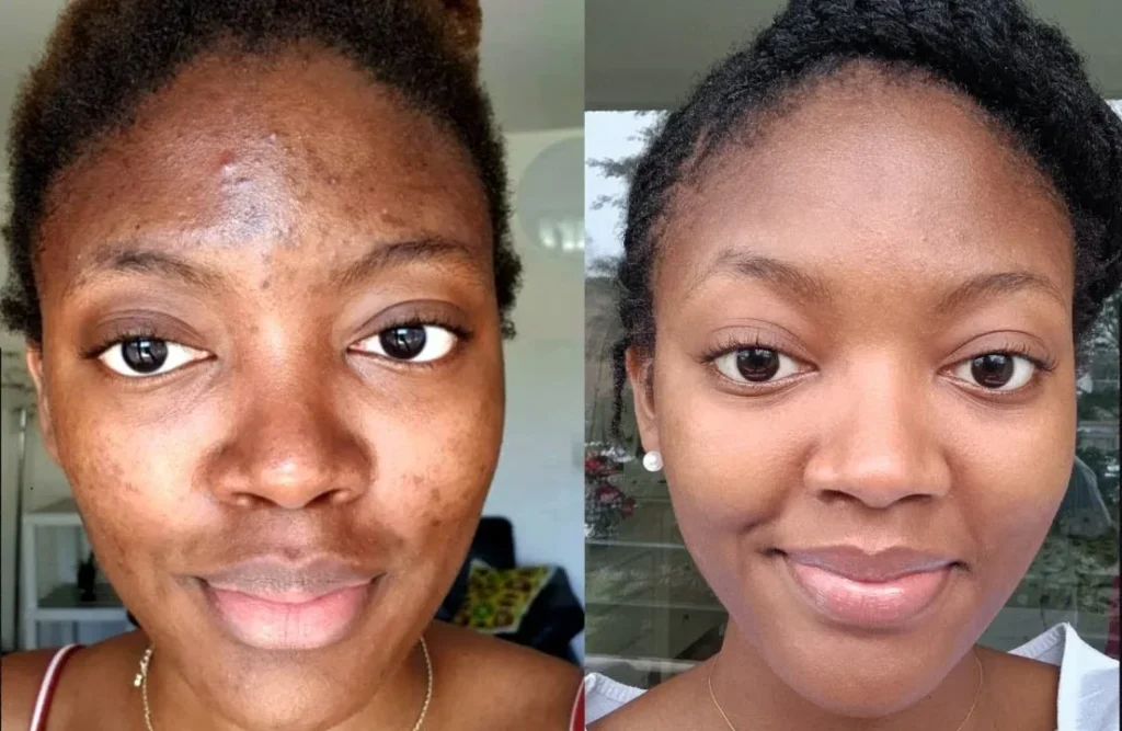 Retirer l’Acné en 7 Jours