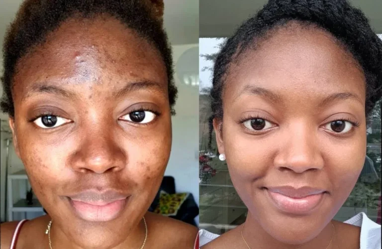 Retirer l’Acné en 7 Jours