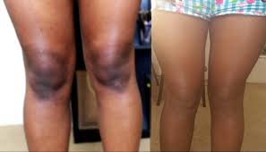 éclaircir les genoux et coudes \